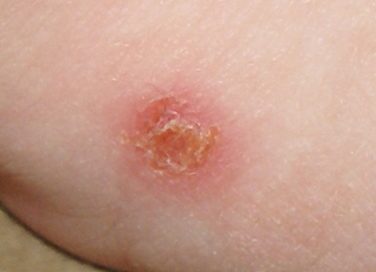 А это прышик на запястьи правой руки - на руке.jpg