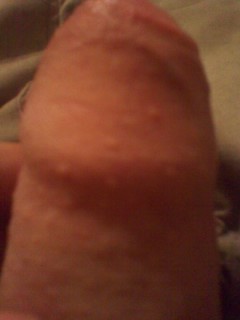 Непонятные комки на члене. - 4len.JPG