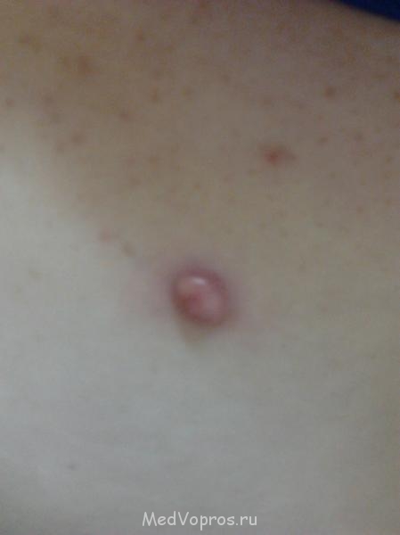 Кровяной нарост на коже - Фото0066.jpg