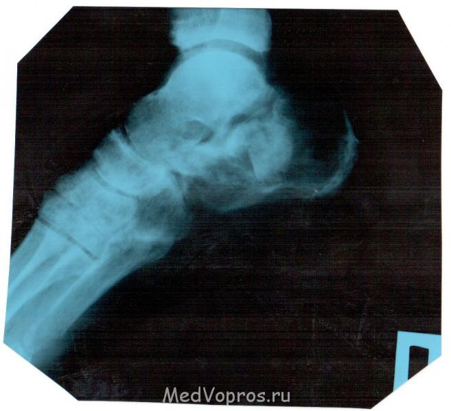 Перелом пяточной кости - Изображение 006.jpg