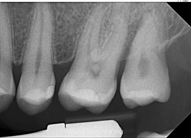 Ренген - Med - tooth 2012 Aug 28.JPG