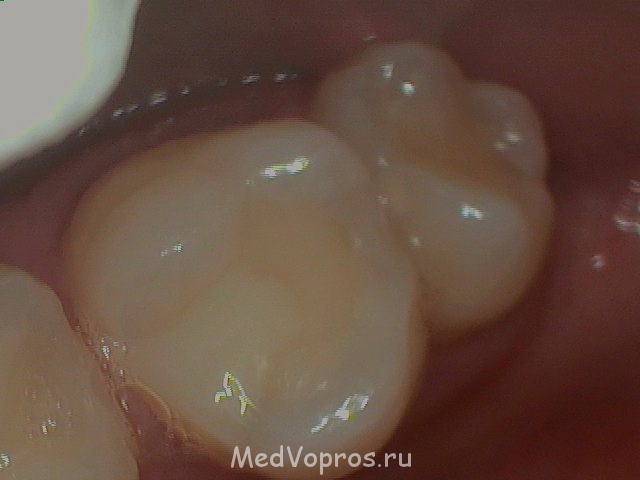Зуб - Med - tooth 2012 Aug 28 - 002.JPG