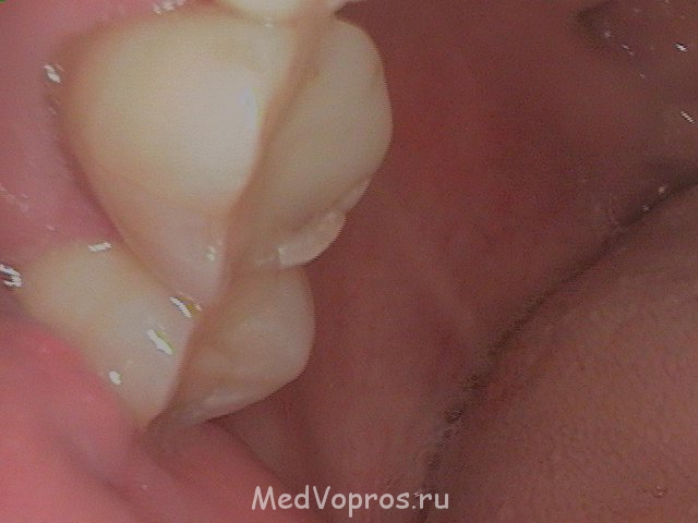 Зуб 2 - Med - tooth 2012 Aug 28 - 003.JPG