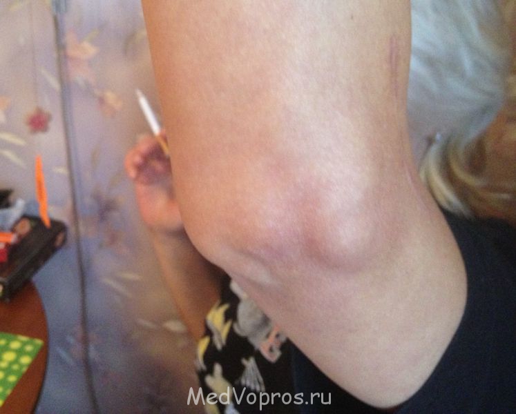 Деформирующий остеоартроз левого локтевого сустава - IMG_4948.JPG