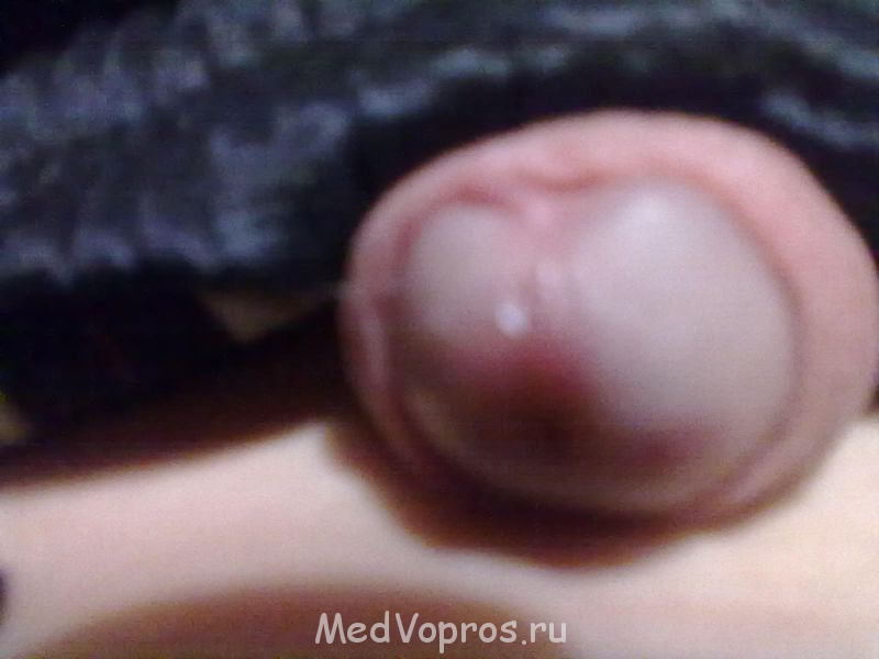 Воспалилась головка члена - 09122013263.jpg
