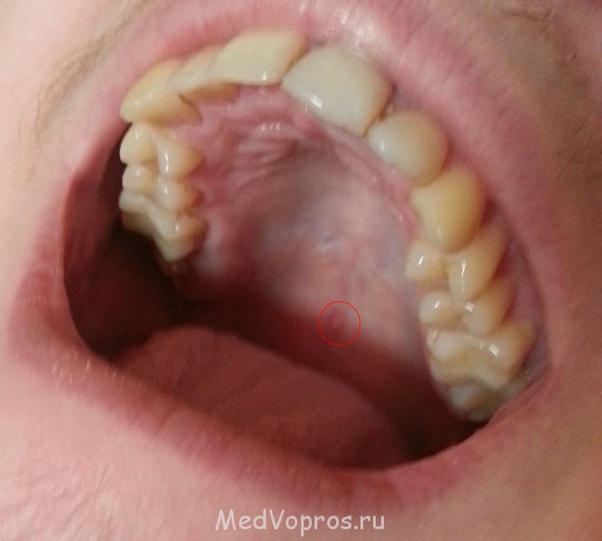 Пузырь Волдырь во рту - 20140807_110032.jpg