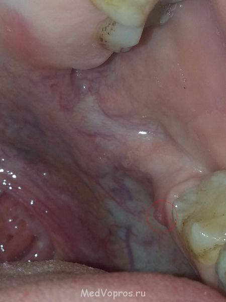 Пузырь Волдырь во рту - 20140825_185454.jpg