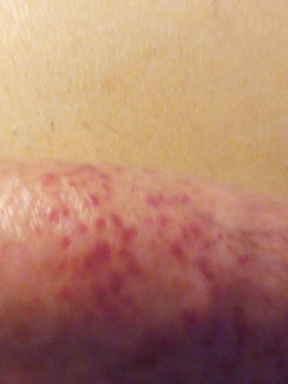 Синяк на члене ? ? ? - IMG_20160114_222518.jpg