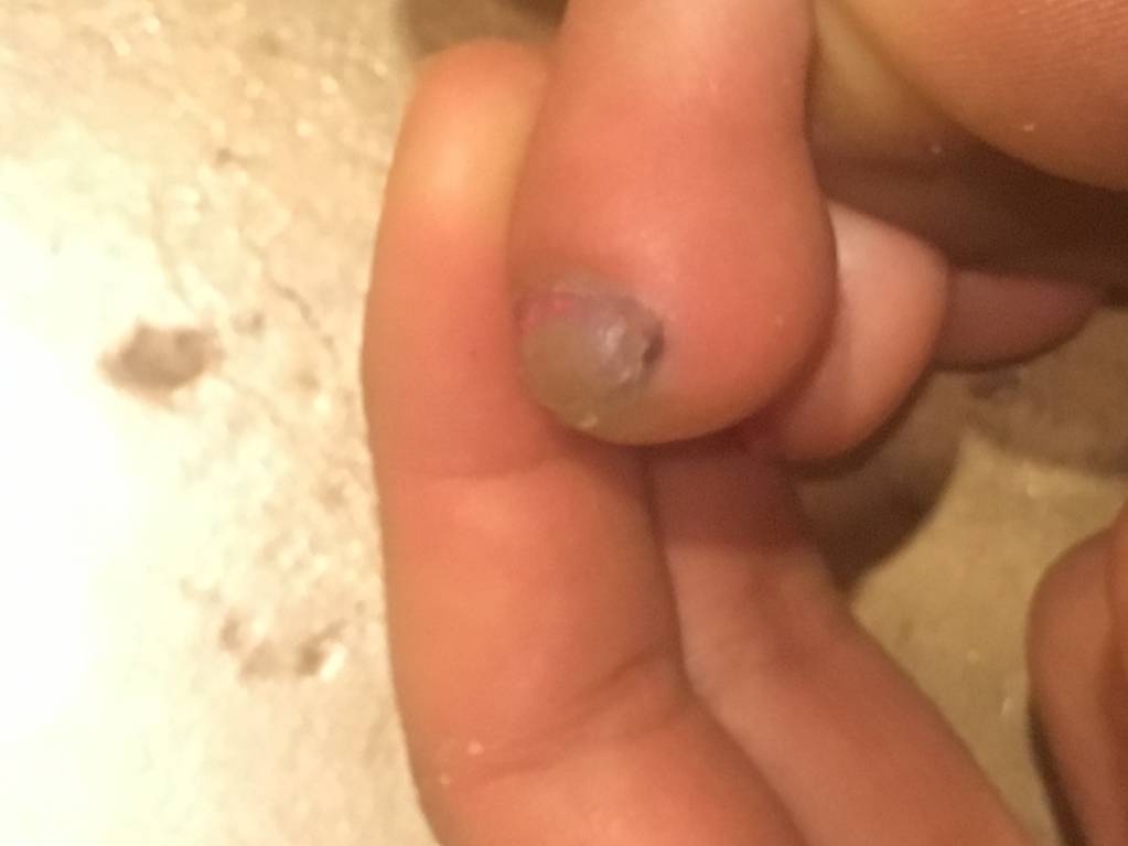 Синяк под ногтем - image.jpeg