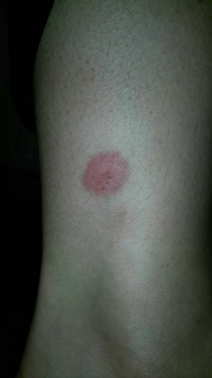 пятно на ноге - X5FI3HkZXi4.jpg