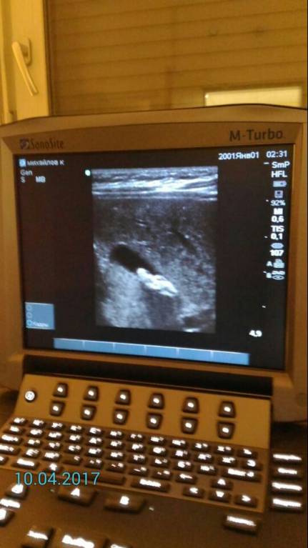 Камни у малыша с рождения? - ^23485DE77694586C24F923CCF2693CA647F4FDC8A2229AD659^pimgpsh_fullsize_distr.jpg