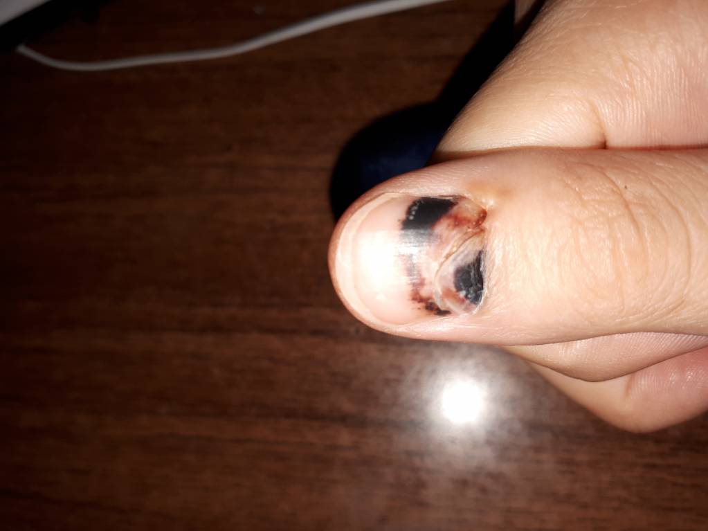 Гематома под ногтем - 20170725_222503.jpg