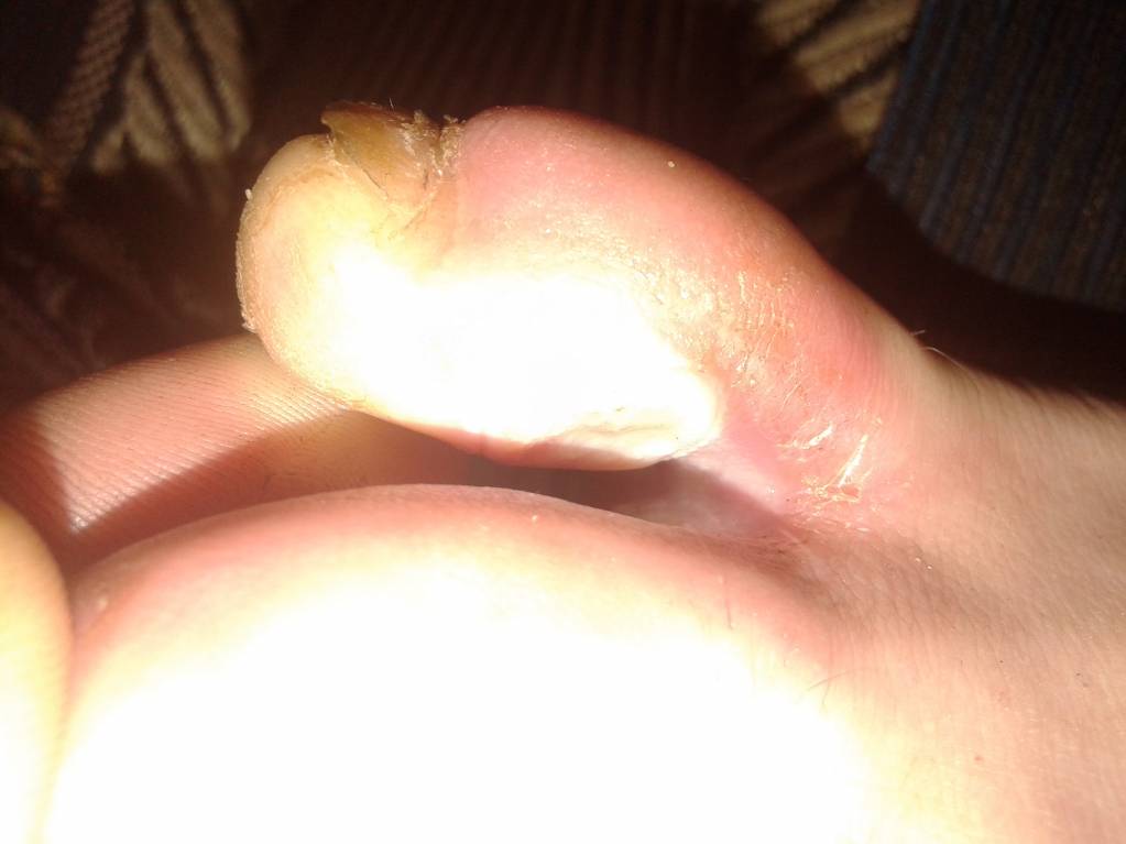 У меня вот такие ранки на обеих ногах мнжду 4 и 5 пальцами. Что делать.? - IMG_20170809_201642.jpg