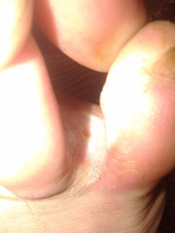 Открытая язва между пальцами - IMG_20170809_201742.jpg