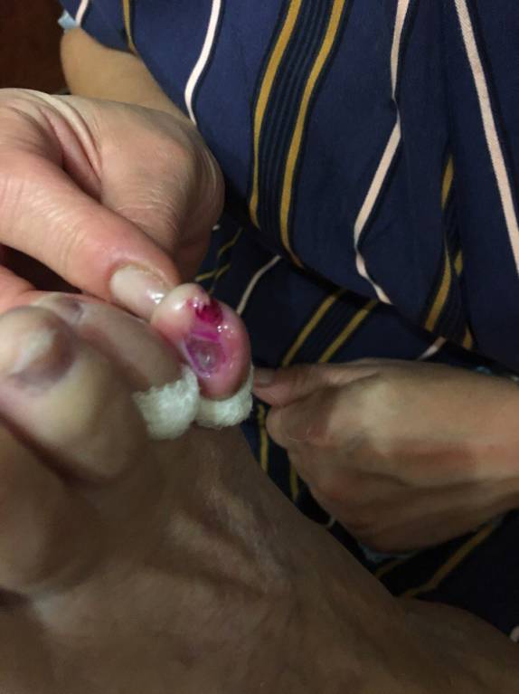 Открытая язва между пальцами - Ce69kDfZpKk.jpg