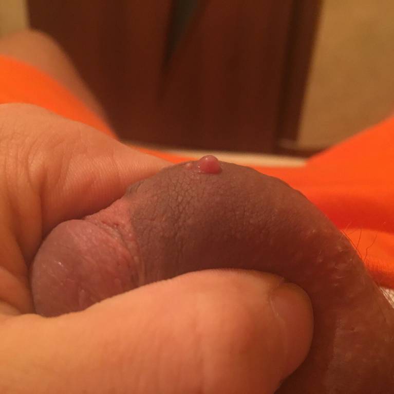 Прыщ на члене - PHdBc4oI01E.jpg