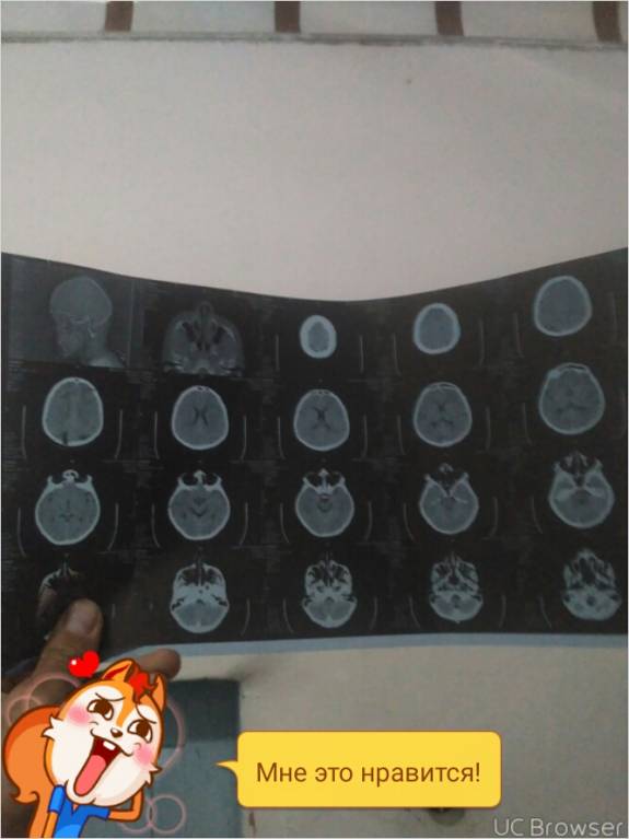 Здравствуйте скажите пожалуйста кто мне может ответить на этот вопрос, на этот снимок ренгенский здесь серьёзные проблем - TMPDOODLE1527436924310.jpg