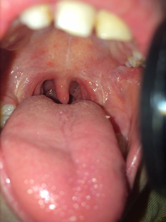 Начало Ангины фолликулярной - 2F45876E-44E7-41C3-9393-83690454DE99.jpeg