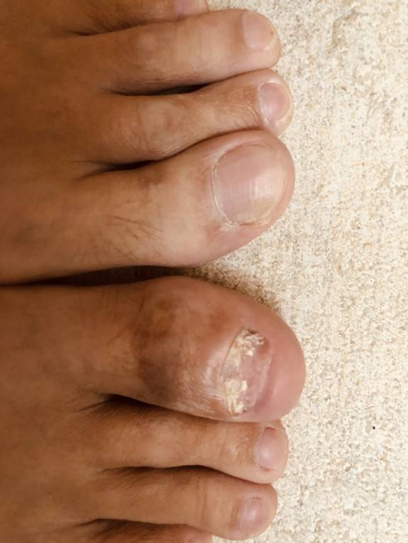 Что с пальцем ноги? - 44817FC9-92D5-4AE6-9D0B-D4C28FD23DDB.jpeg