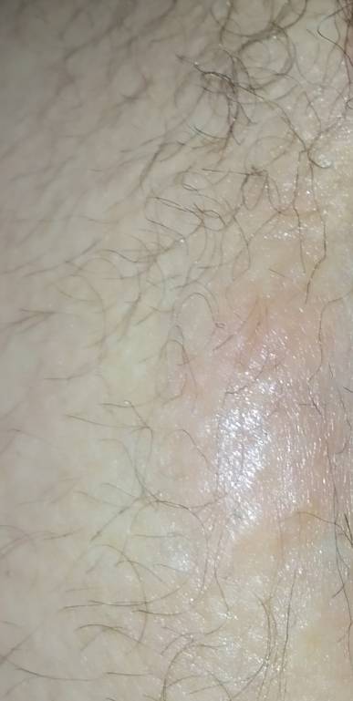 Непонятный волдырь - IMG_20190718_093148.jpg