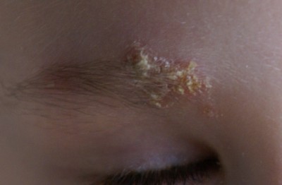 А это сегодня (без вспышки). Видите слева, внутри бровки есть ещё покраснение?