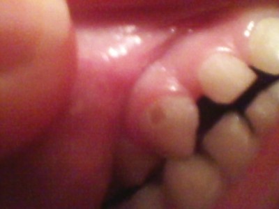 откололись или раскрошились два зуба у ребенка - .jpg