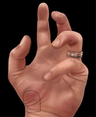 шишка на этом месте