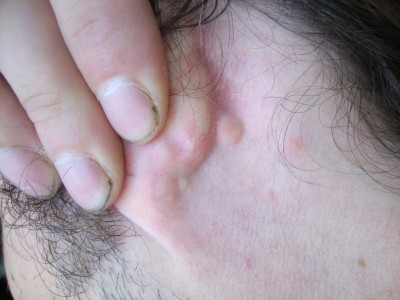 жировик или атерома? - DSC02610.JPG