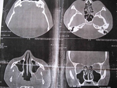 Разрастание слизистой в решетках - 131552980.jpg