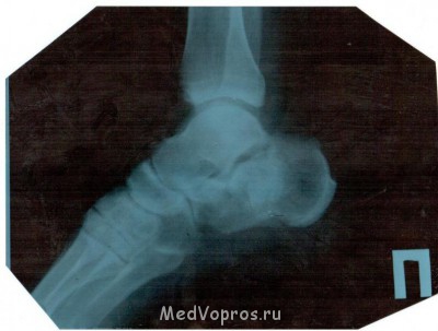 Перелом пяточной кости - Изображение 001.jpg