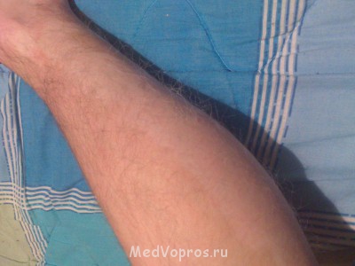 Побеление участков кожи - DSC_0071.jpg