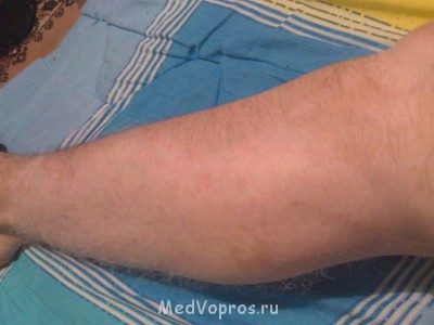 Побеление участков кожи - DSC_0069.jpg