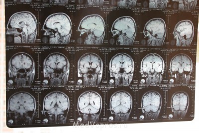 Арахноидальная киста - IMG_2819.JPG