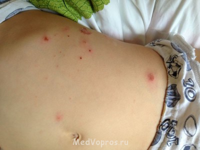 Язвы на коже у двухлетнего мальчика - image.jpg