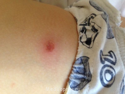 Язвы на коже у двухлетнего мальчика - image.jpg