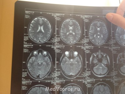 Наружная заместительная гидроцефалия - image.jpg