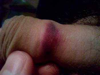 Синяк на члене ? ? ? - IMG_20150401_015806.jpg