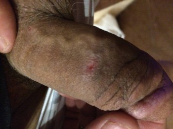 появление непонятных прыщей на члене - image.jpg