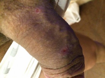 появление непонятных прыщей на члене - image.jpg