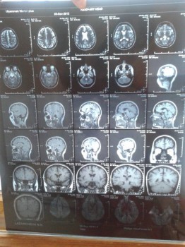 Гидроцефалия - 20160302_165858.jpg