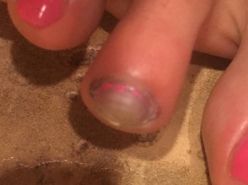 Синяк под ногтем - image.jpeg