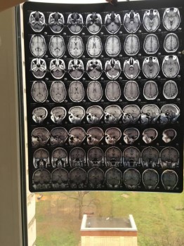 Киста шишковидной железы головного мозга - IMG_5024.JPG