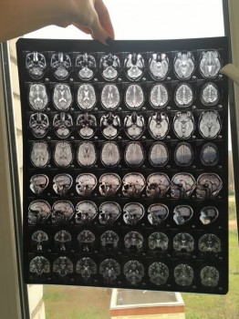 Киста шишковидной железы головного мозга - IMG_5025.JPG