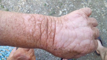 Вопрос к дерматологам. Что за образование? - IMG_20160623_192625.jpg