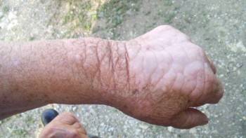 Вопрос к дерматологам. Что за образование? - IMG_20160623_192632.jpg